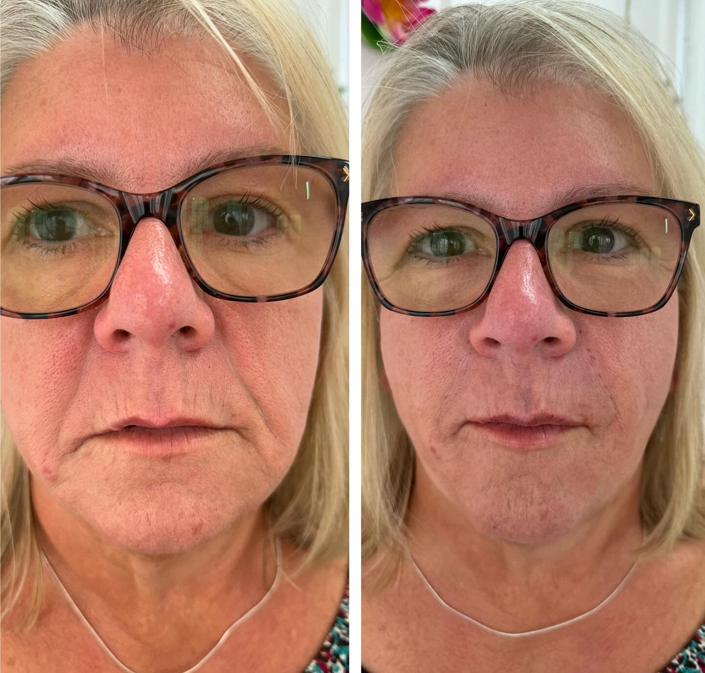 Before and after aesthetic treatment results at Loft Aesthetics clinic