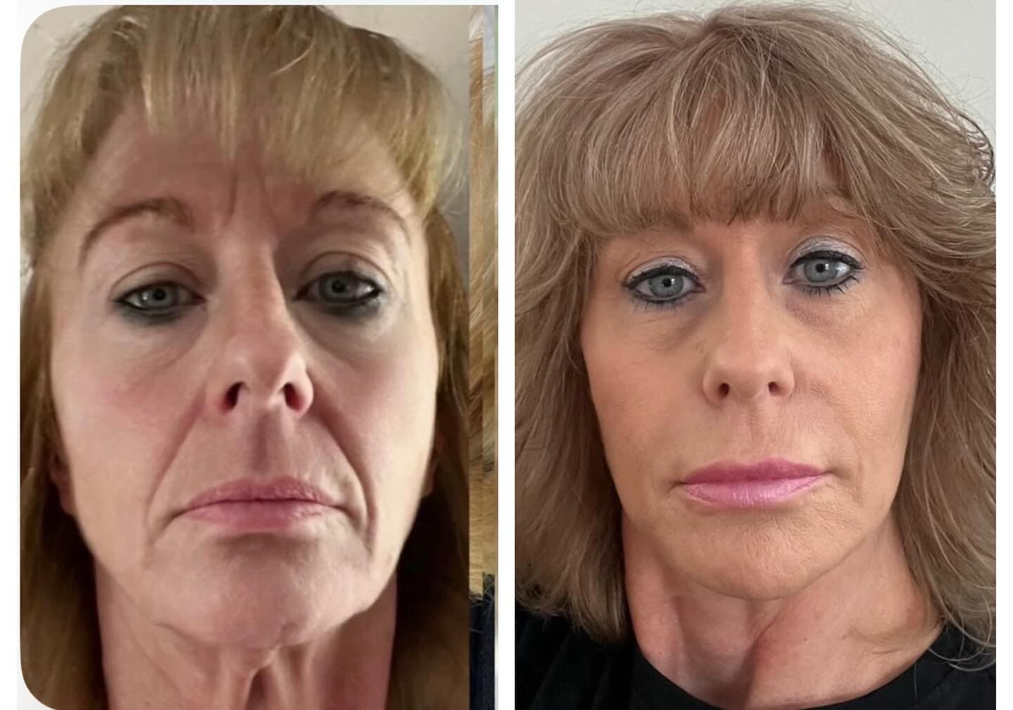 Before and after aesthetic treatment results at Loft Aesthetics clinic