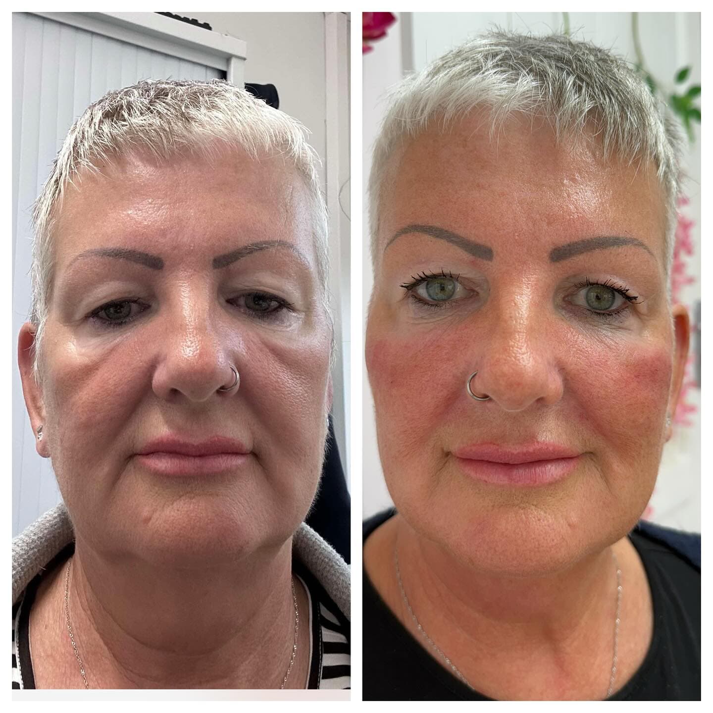 Before and after aesthetic treatment results at Loft Aesthetics clinic